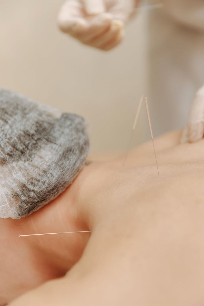 Free Sample of Acupuncture Needles
